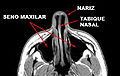 Maxillary sinus MRI es.jpg