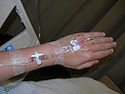 Intravenous therapy 2007-SEP-13-Singapore.JPG
