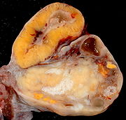 Human Ovary with Fully Developed Corpus Luteum.jpg
