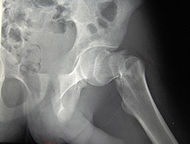 Cdm hip fracture 343.jpg