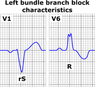 Left bundle branch block ECG characteristics.png