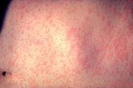 Morbillivirus measles infection.jpg