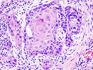 Oral cancer (1) squamous cell carcinoma histopathology.jpg