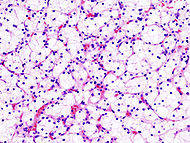 Renal clear cell ca (1) Nephrectomy.jpg