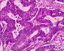 Adenocarcinoma highly differentiated (rectum) H&E magn 400x.jpg