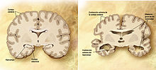 Cerebro corte frontal Alzheimer.jpg