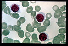 Hairy cell leukemia.jpg