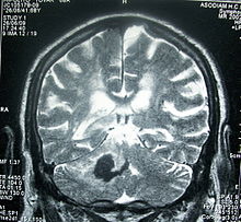 Head MRI stroke.JPG