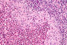 Langerhans cell histiocytosis - very high mag.jpg