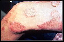 Leprosy thigh demarcated cutaneous lesions.jpg