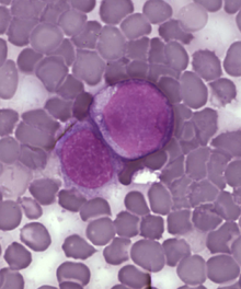 Leukemia cells.png