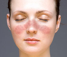 Lupus facial rash.jpg