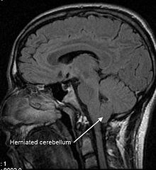 MRI of human brain with type-1 Arnold-Chiari malformation and herniated cerebellum.jpg