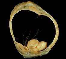 Mature cystic teratoma of ovary 2.jpg