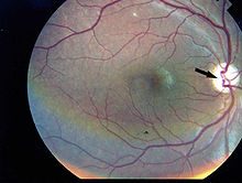 Photographic image of the patient right eye showing optic atrophy without diabetic retinopathy Wolfram syndrome.jpg