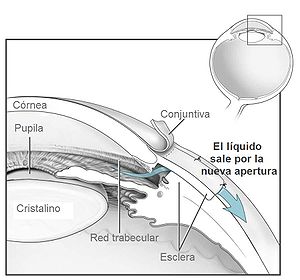 Conventional surgery to treat glaucoma EDA11-es.jpg