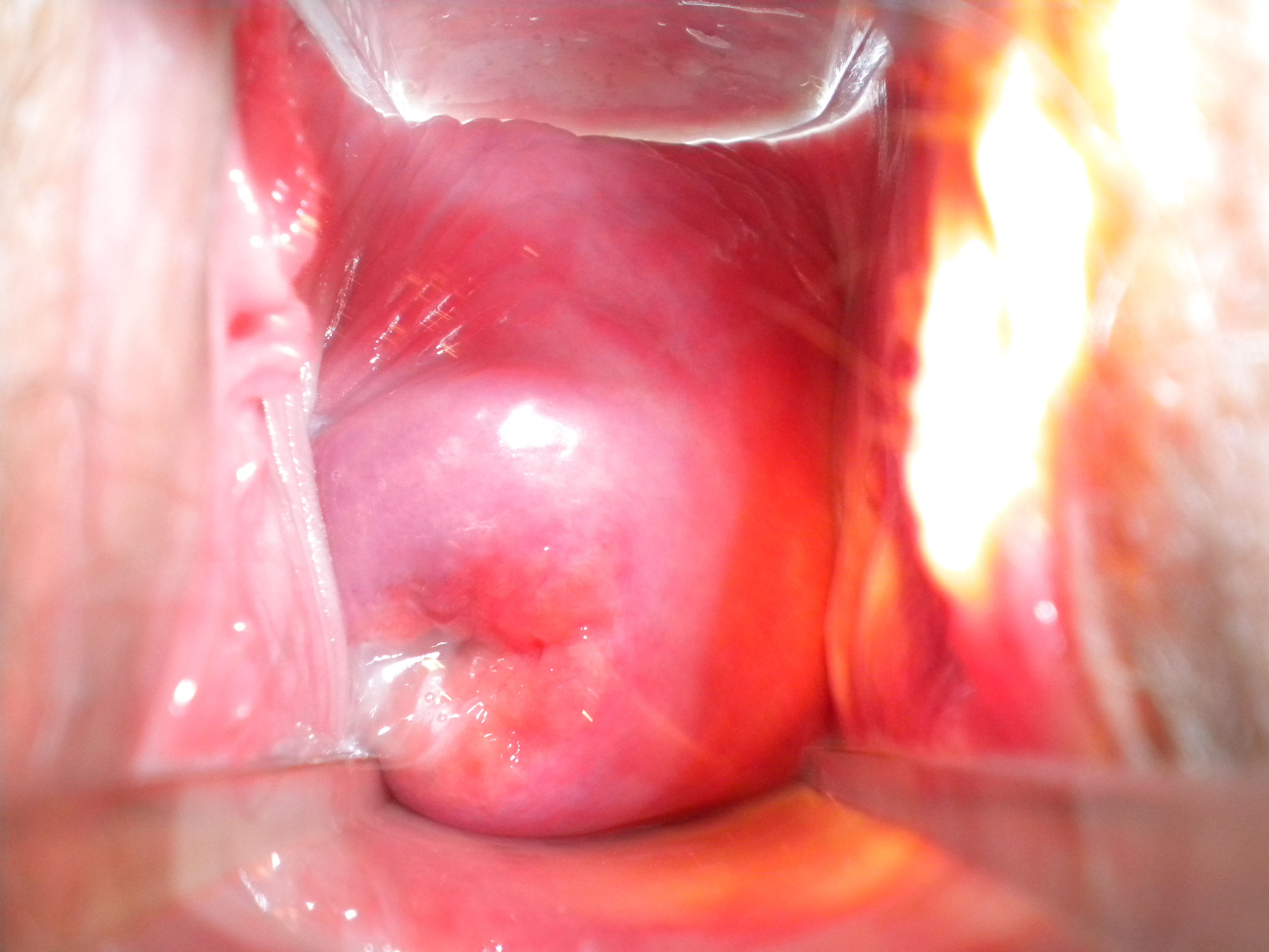 varicoza canal de col uterin