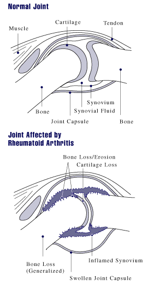 Rheumatoid arthritis joint.gif