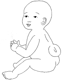 Spina bifida drawing.gif